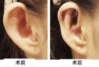 招风耳整形手术风险分析